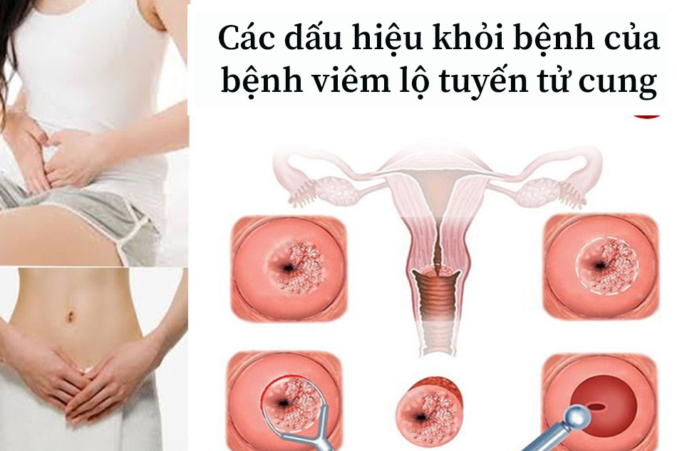 Các dấu hiệu khỏi bệnh của bệnh viêm lộ tuyến tử cung
