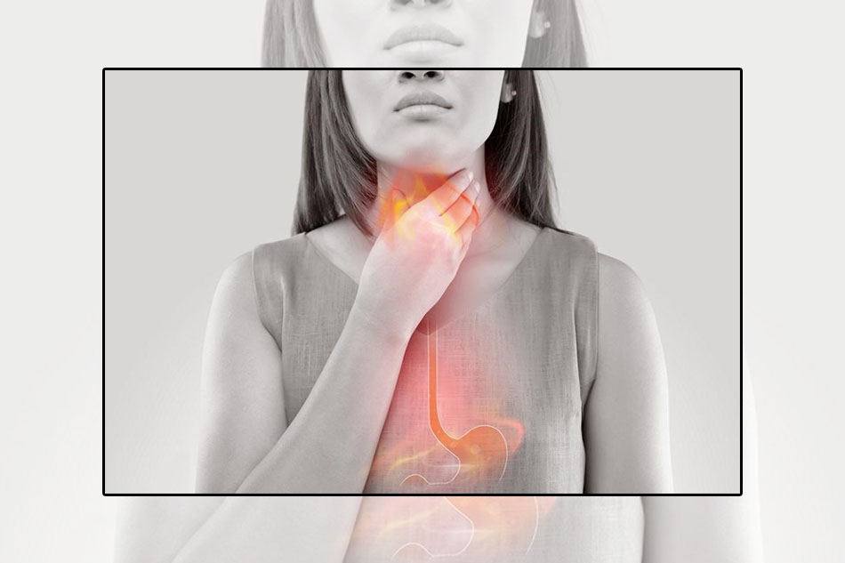 Triệu chứng phổ biến nhất của trào ngược dạ dày - thực quản là ợ nóng