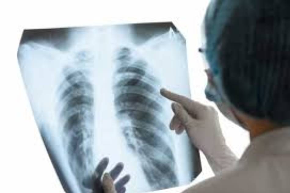 X quang lồng ngực chẩn đoán tràn khí màng phổi